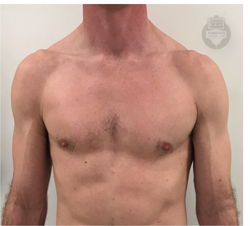 Pectoralis Major Rupture